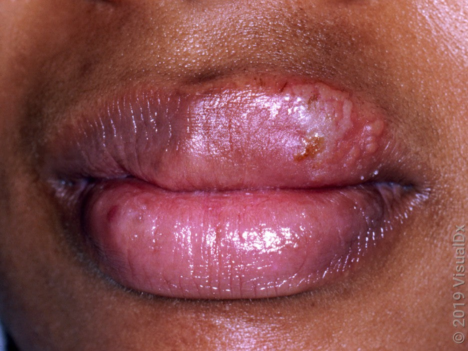 He Said It Was Just Razor Burn on His 🍆… Turns Out It Was Herpes — and Now She Has It Too 😷