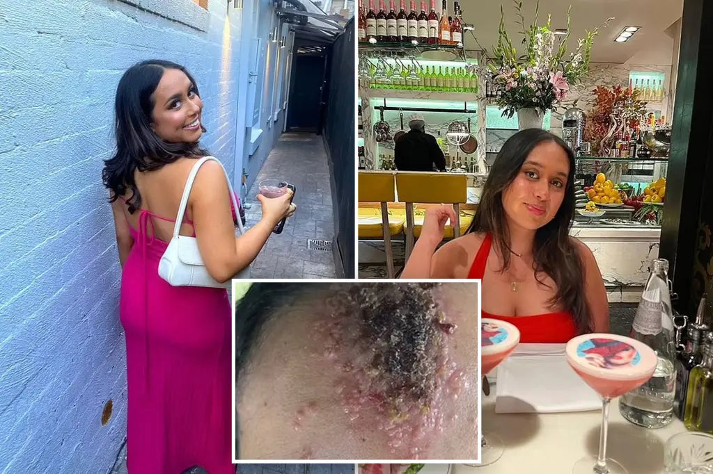Girl Contracts Herpes After Music Festival — Experts Warn It’s More Common Than You Think