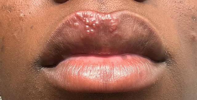 Teen Girl Gets Oral Herpes After Kissing Strangers in Truth-or-Dare Game 😬