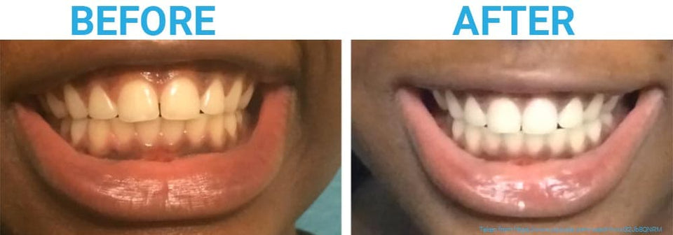 Experience a Brighter Smile with Our Activated Charcoal Teeth Whitening Powder